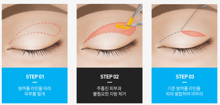 상안검 수술 성형외과 찾을 때 이것을 꼭 확인하세요. 관련 이미지 3