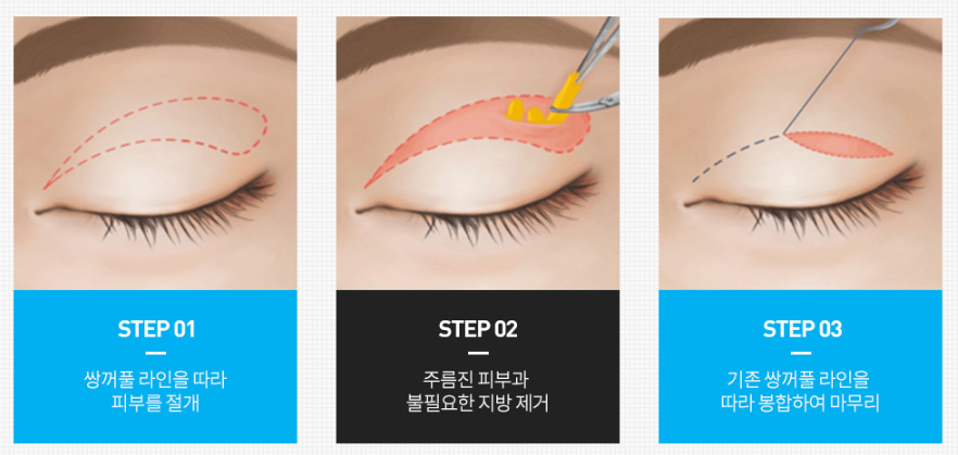 Why Searching for Before-and-After Photos of Upper and Lower Blepharoplasty Is Pointless image 3