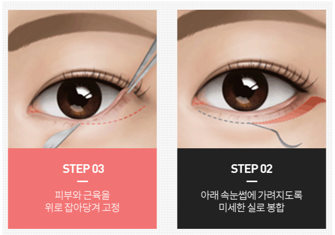 Organizing Midlife Eye Surgery in Sinsa-dong. image 5