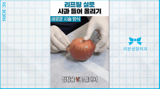 Why Is 1:1 Consultation Important for Marionette Wrinkle Treatment? image 2