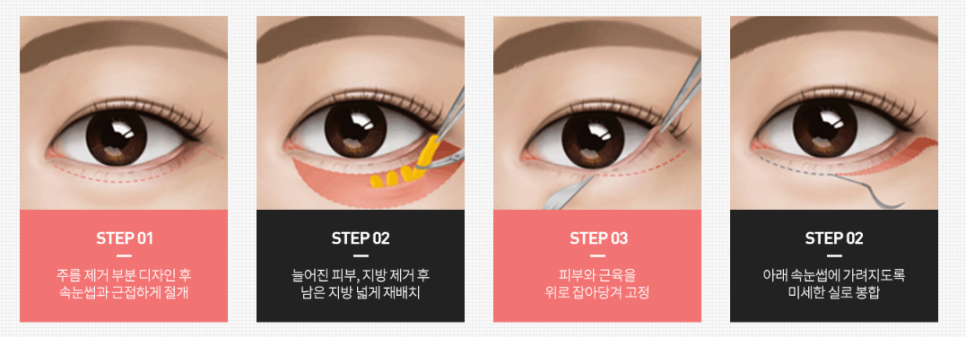 What Matters More Than the Price of Upper and Lower Eyelid Surgery? image 3