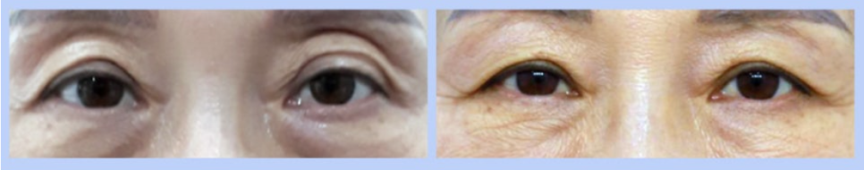 Upper Eyelid Fat Grafting Cost: For a Younger, More Vibrant Appearance image 1