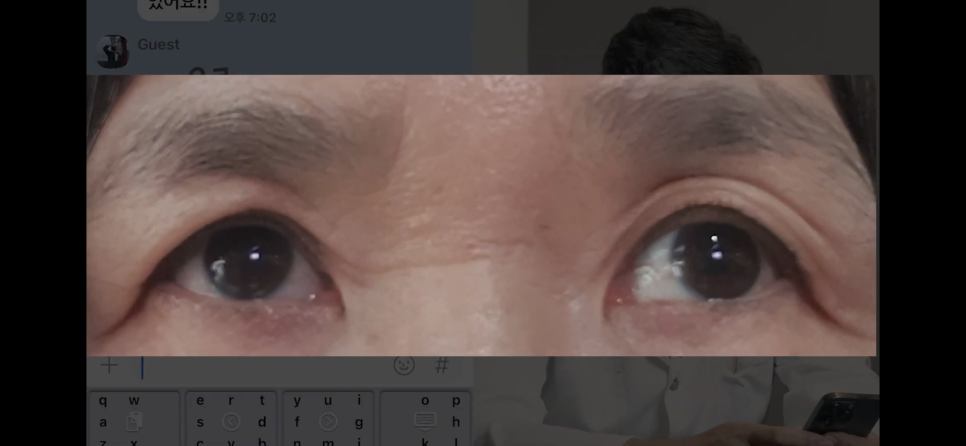 눈꺼풀처짐에 눈꺼풀실리프팅? 중년눈성형? 후기도 확인하자 관련 이미지 1