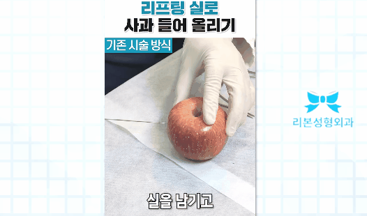 얼굴실리프팅가격 비용 얼굴 처짐이 신경쓰이기 시작한다면 관련 이미지 2