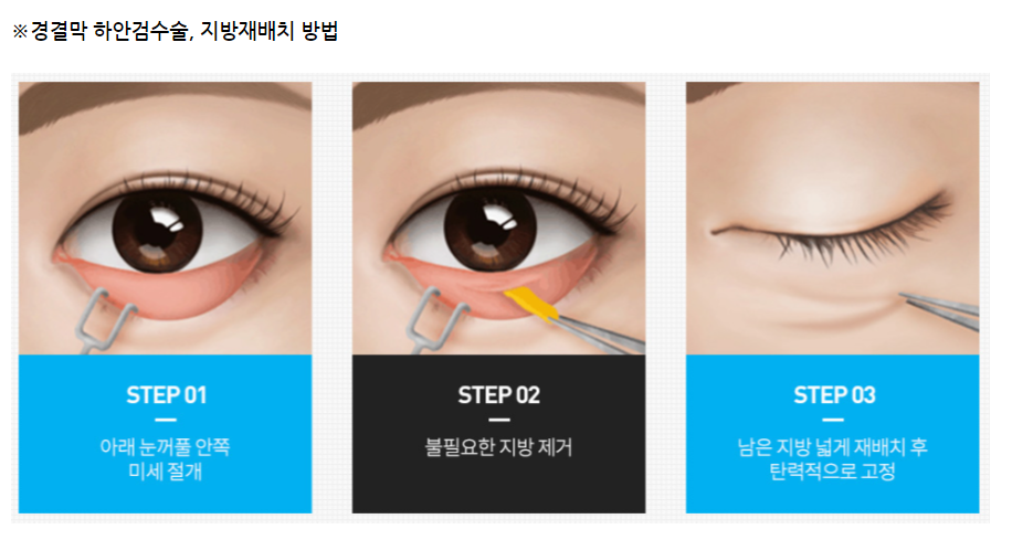 신논현 성형외과? 중년눈성형, 상안검/하안검 최종 정리하세요. 관련 이미지 3
