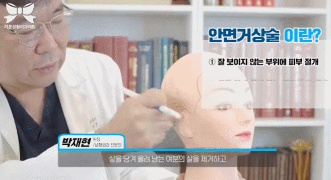 신사역안면거상 부작용, 회복기간, 흉터 걱정되는 분들은 확인하세요. 관련 이미지 5