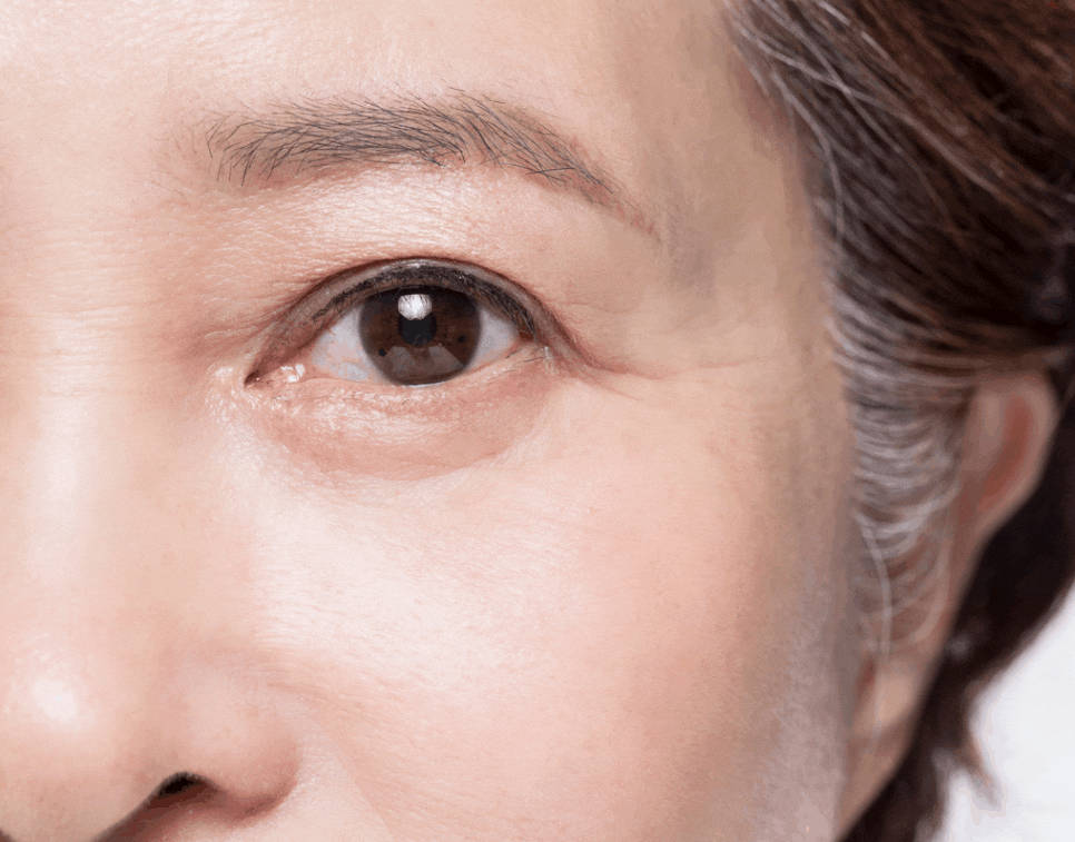 Can fat grafting help when hollow eyelids make you look older? image 4