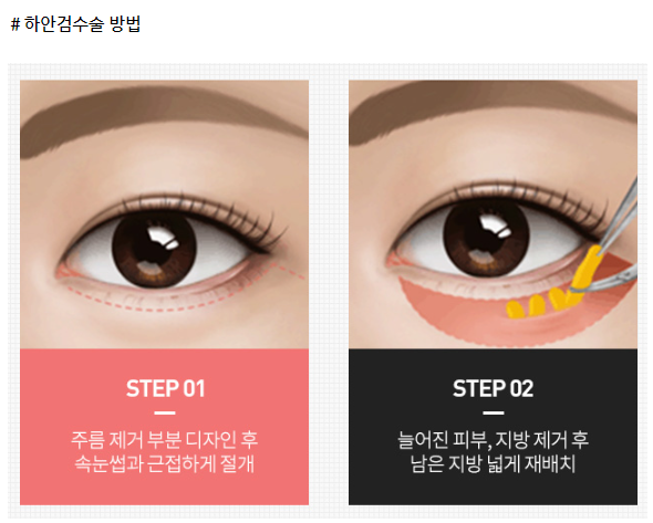 상안검하안검수술 부작용 걱정된다면 이 글을 필독해주세요 관련 이미지 5