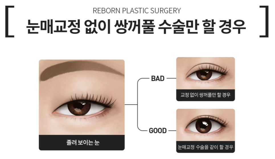 신사동 눈매교정 잘하는곳? 관련 이미지 2
