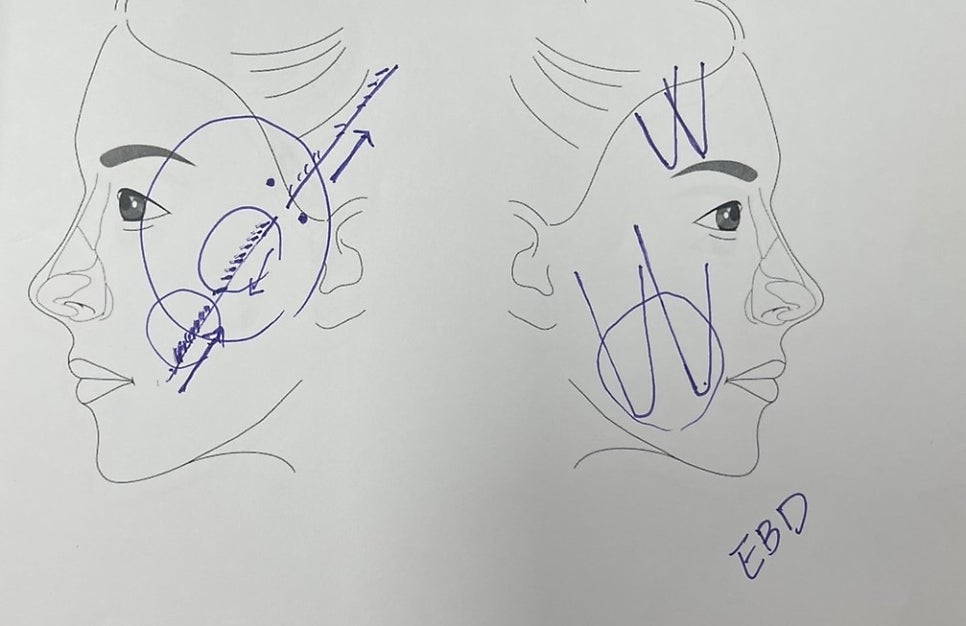 Why Does a Silhouette Lift Make the Cheekbones Look Bigger? How Can It Be Prevented? image 2