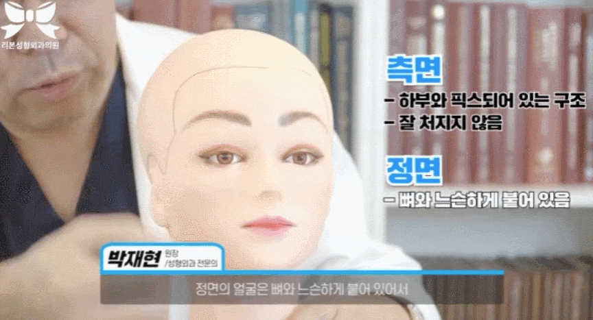 신사동 안면거상술 유명한곳? 피부만 당기면 실패할 확률 높습니다. 관련 이미지 5