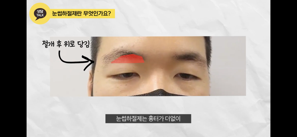 눈꺼풀처짐에 눈꺼풀실리프팅? 중년눈성형? 후기도 확인하자 관련 이미지 3