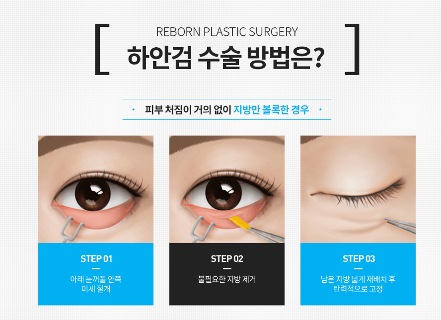 압구정눈성형 상안검 하안검 수술 내돈내산 아깝지 않게 관련 이미지 4