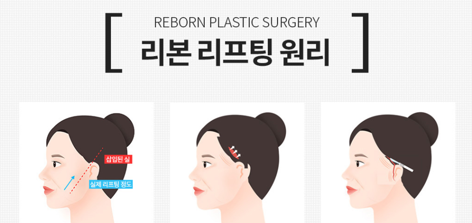 신사 미니리프팅 결과 후회없이 관련 이미지 3