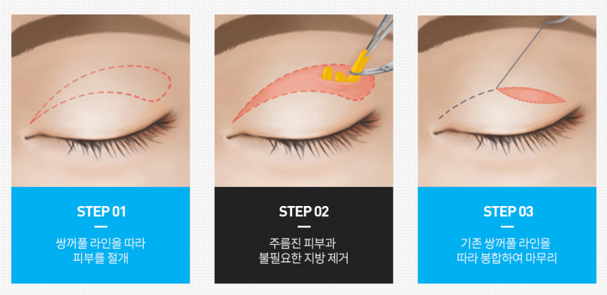 신사 상안검수술 잘하는곳? 많은 피부량 절제, 주의해야 하는 이유 관련 이미지 2