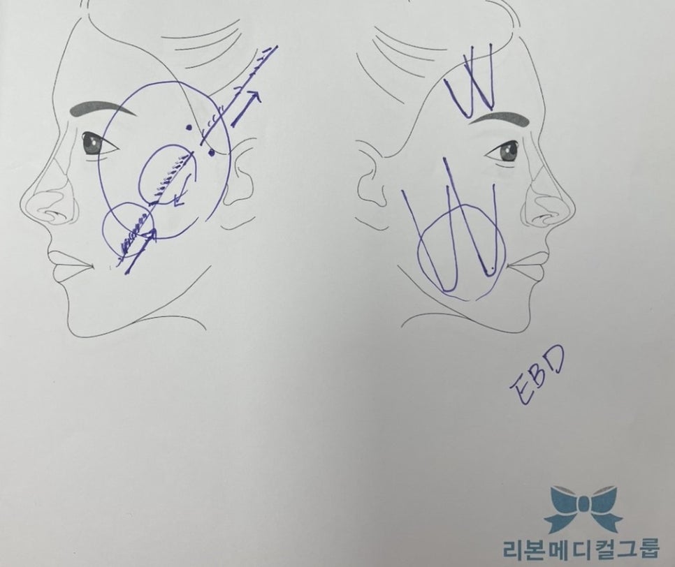 브이라인실리프팅 잘하는 곳 &lsquo;이것&rsquo; 반드시 필요합니다. 관련 이미지 2