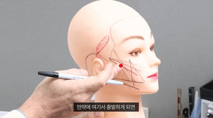 Why I Recommend Thread Lifting in Nonhyeon Station: One Reason image 4