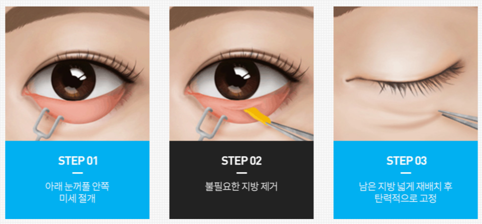 신사역 하안검수술 잘하는곳, 이 글로 쉽게 정리하세요. 관련 이미지 4