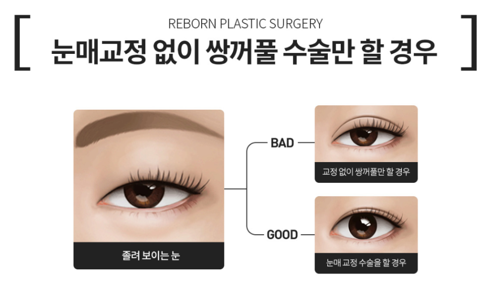 눈매교정 쌍꺼풀 수술 관련 이미지 3