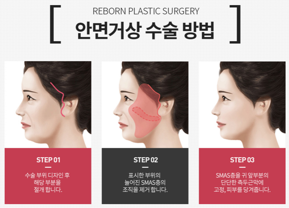 신사역 안면거상술 관련 이미지 2