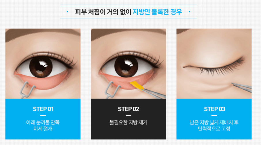 상안검하안검수술 전후 사진보다 이것 확인하세요 관련 이미지 4