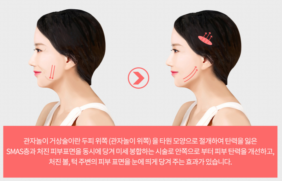 A Recommended Procedure for Those Who Feel Facelift Surgery at Sinsa Station Is Too Much image 3