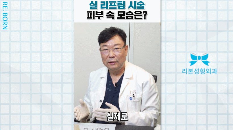 중안면부거상 수술 멍, 부기, 흉터, 회복기간 걱정된다면? 관련 이미지 2