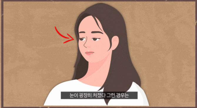 Eyelid Muscle Surgery and Eye Correction? I’ll Explain It Clearly. image 2
