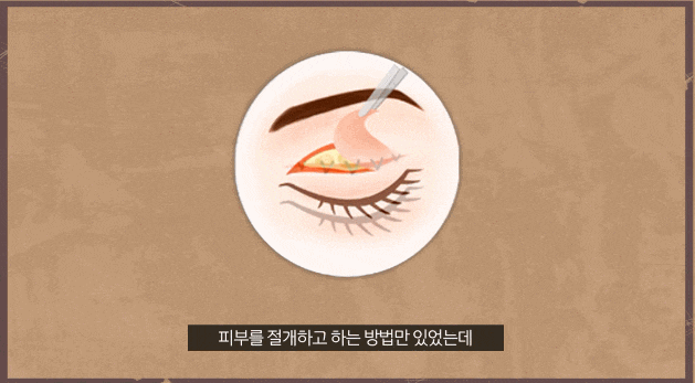 안검하수 눈매교정 수술 전후 사진 찾는 분들에게... 관련 이미지 5