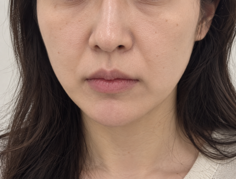 신사역 실리프팅 성형외과 패임, 딤플, 어색한 표정이 걱정된다면? 관련 이미지 3