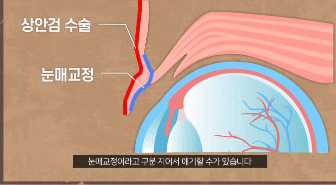강남눈매교정성형외과 무조건 만족스러운 건 아닙니다 관련 이미지 2