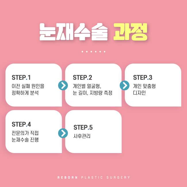 강남눈재수술 꼭 체크해야 할 포인트 관련 이미지 2