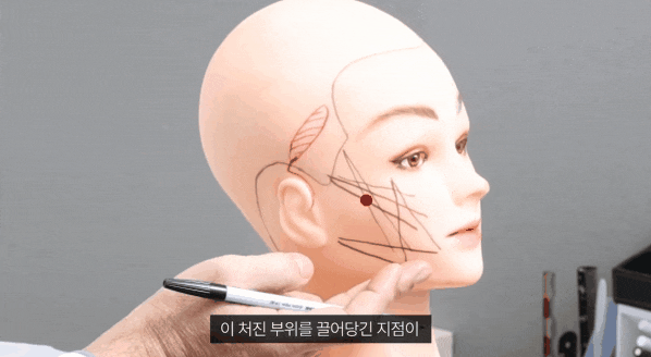 중안면부 리프팅 성형외과 전문의가 말하는 주의사항은? 관련 이미지 1