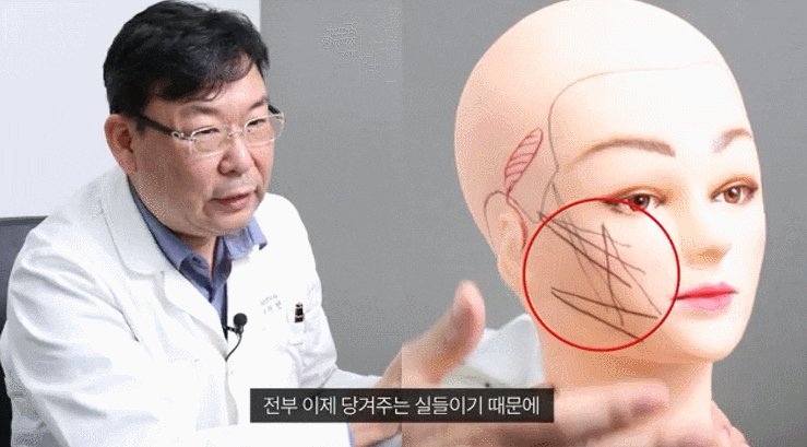 Why I Recommend Thread Lifting in Nonhyeon Station: One Reason image 5