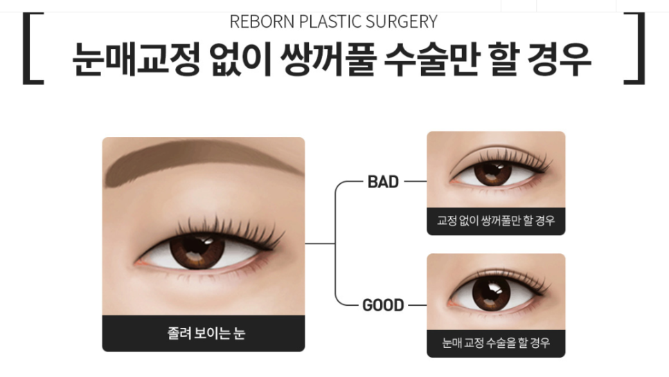 What happens if you only get double eyelid surgery when you have ptosis? Why do you need eyelid correction? image 4
