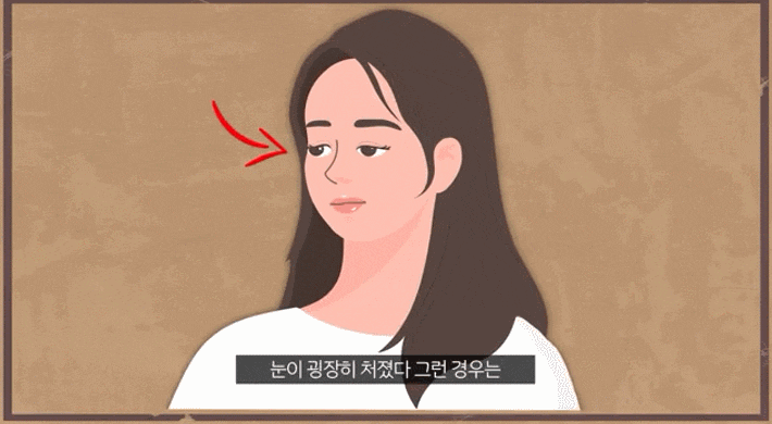 신논현역 눈매교정 잘하는 성형외과 찾기 전 필독해주세요. 관련 이미지 2