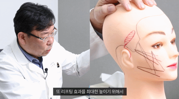 Precautions Mentioned by a Plastic Surgery Clinic for Thread Lifting at Sinsa Station image 1