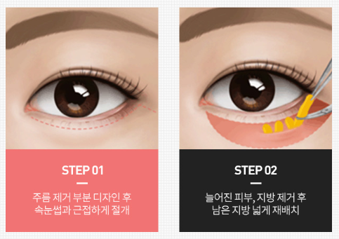 상안검 하안검수술 전후사진 찾는 분들에게... 관련 이미지 3