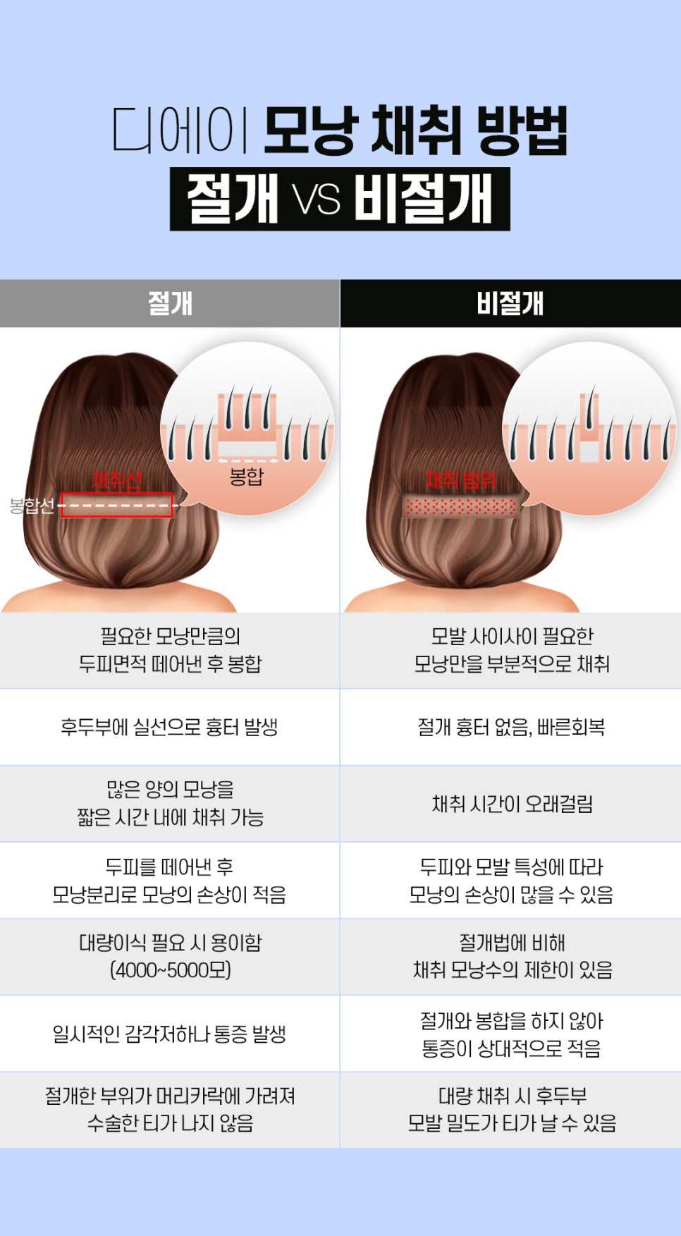 헤어라인 모발이식으로 인형외모갖기 관련 이미지 7