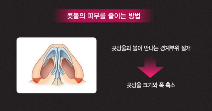 이상적인 코성형, 그 방법은? 관련 이미지 11