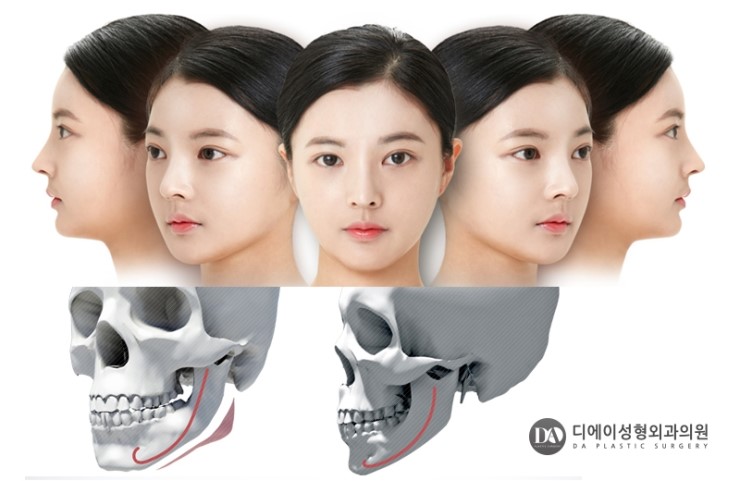 안면윤곽, 어떤 얼굴형이 큰 효과를 볼 수 있나? 관련 이미지 4