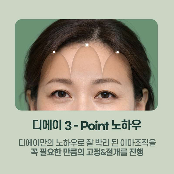 이마주름과 눈처짐을 동시에 개선, 수직 이마거상 관련 이미지 9