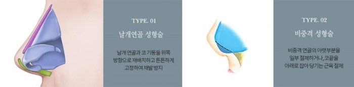 이상적인 코성형? A-Z 코유형별 방법을 알아보자 관련 이미지 14
