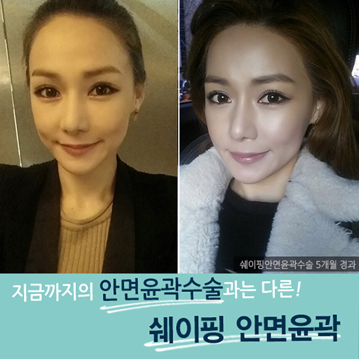 최소 절제, 최상의 효과! DA성형외과 쉐이핑안면윤곽 관련 이미지 4