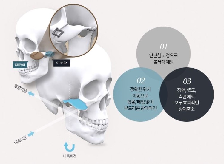[디에이성형외과] 광대축소술 논문 발표 관련 이미지 3