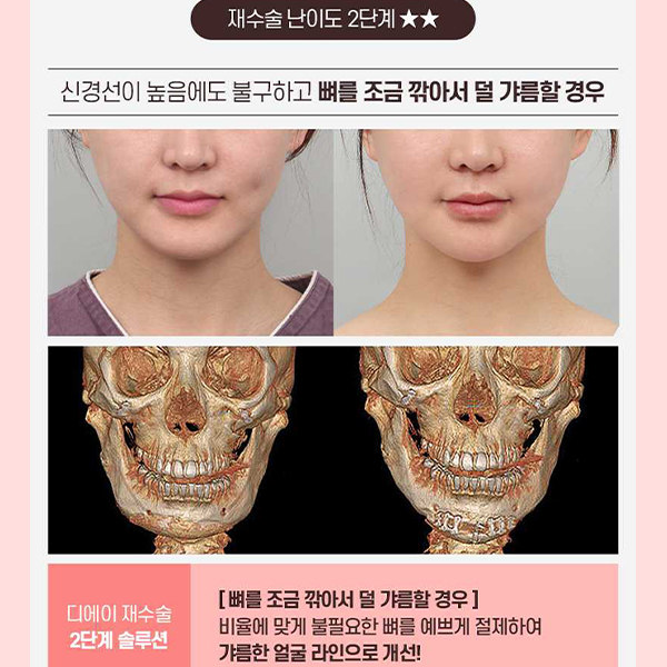 Not Satisfied After Your First Surgery? A Guide to Revision Facial Contouring Surgery image 7
