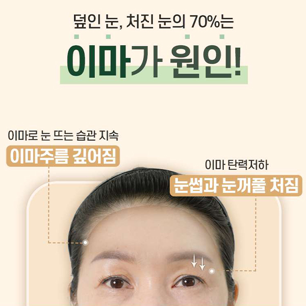이마주름과 눈처짐을 동시에 개선, 수직 이마거상 관련 이미지 2