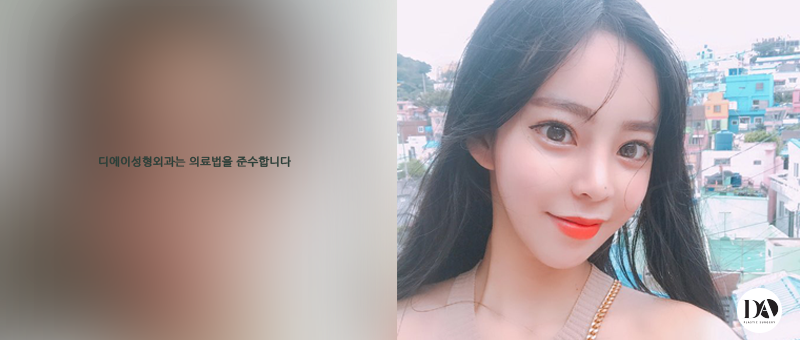 오차가 만드는 큰 차이, 디에이 양악수술 관련 이미지 10