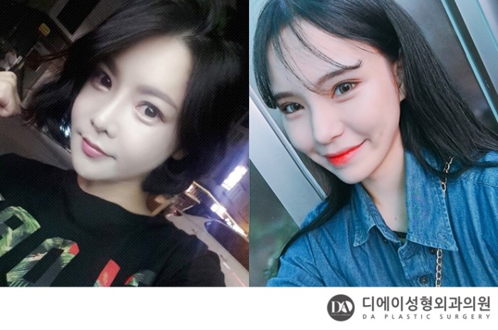 성공적인 눈성형, 관건은 눈형태에 따른 수술법 선택 관련 이미지 12