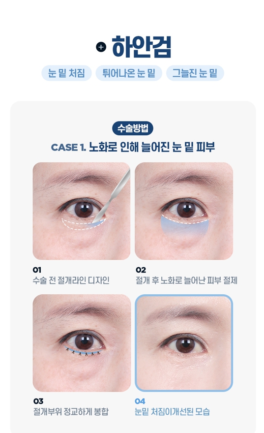 중년 눈성형, 처진 눈꺼풀의 원인에 따라 수술법이 달라집니다 관련 이미지 5